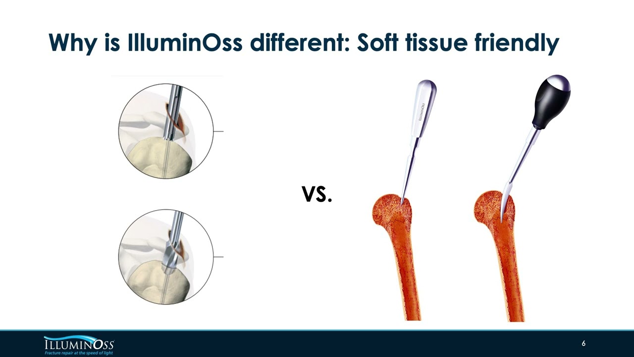 Antegrade Rush nailing for fractures of the distal humerus | Bone & Joint